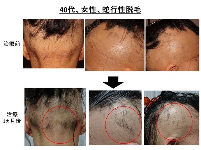 円形脱毛症　病院""